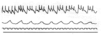 Рис. 4. Сфигмограмма собаки (по П. В. Филатову)Кривая одновременной записи