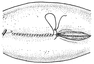 143.     (Hysterectomia)