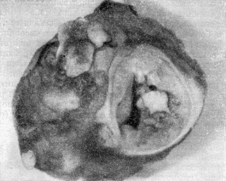 Рис. 147. Распадающаяся раковая опухоль, удаленная из молочной железы собаки