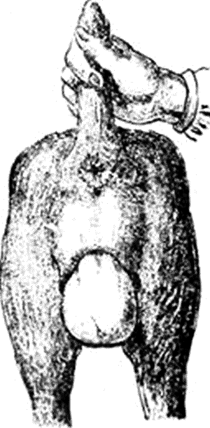 . 65.      (Prolapsus vaginae)